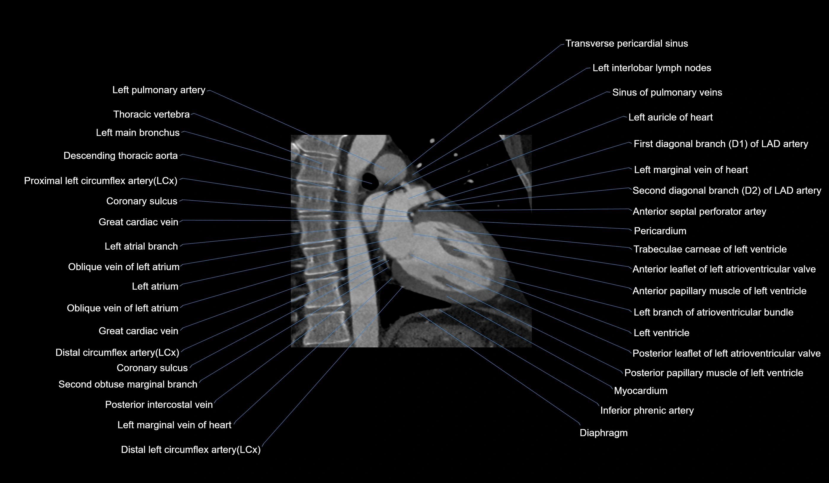 CT heart (coronary angiogram) 2 chamber view cross sectional anatomy labelled radiology image-00011.webp